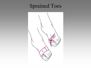 Sprained Toes
 