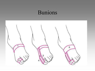 Bunions
 