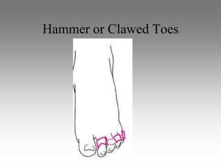 Hammer or Clawed Toes
 