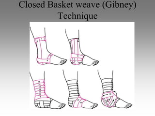 Closed Basket weave (Gibney)
         Technique
 