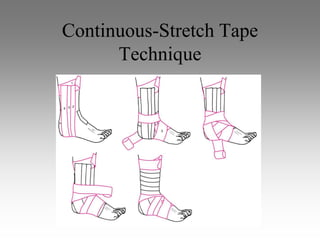 Continuous-Stretch Tape
      Technique
 
