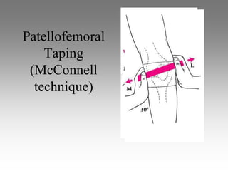 Patellofemoral
    Taping
 (McConnell
  technique)
 