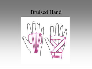 Bruised Hand
 