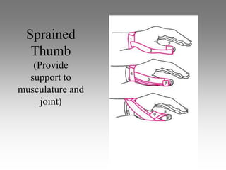 Sprained
  Thumb
   (Provide
  support to
musculature and
     joint)
 