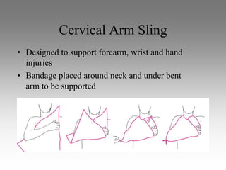 Cervical Arm Sling
• Designed to support forearm, wrist and hand
  injuries
• Bandage placed around neck and under bent
  arm to be supported
 