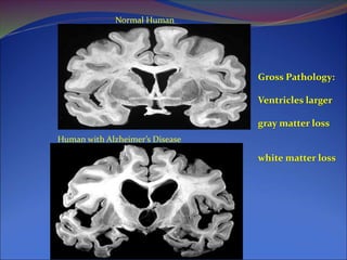 Normal Human
Human with Alzheimer’s Disease
Gross Pathology:
Ventricles larger
gray matter loss
white matter loss
 