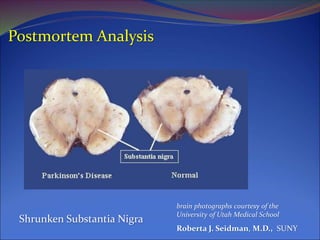 Postmortem Analysis
brain photographs courtesy of the
University of Utah Medical School
Roberta J. Seidman, M.D., SUNY
Shrunken Substantia Nigra
 