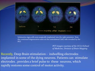Recently, Deep Brain stimulation - indwelling electrodes
implanted in some of the dying neurons. Patients can stimulate
electrodes , provides a brief pulse to these neurons, which
rapidly restores some control of motor activity.
PET images courtesy of the UCLA School
of Medicine, Division of Brain Mapping
Substantia nigra cells were surgically implanted into the right putamen. Note
the continued degeneration seen on the contralateral (left) side revealed by the
PET.
 