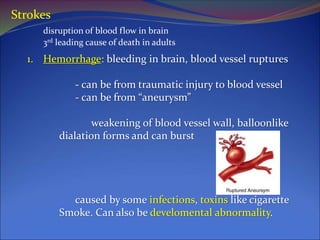 Strokes
disruption of blood flow in brain
3rd leading cause of death in adults
1. Hemorrhage: bleeding in brain, blood vessel ruptures
- can be from traumatic injury to blood vessel
- can be from “aneurysm”
weakening of blood vessel wall, balloonlike
dialation forms and can burst
caused by some infections, toxins like cigarette
Smoke. Can also be develomental abnormality.
 