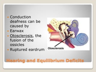 Hearing and Equilibrium Deficits
 Conduction
deafness can be
caused by
 Earwax
 Otosclerosis, the
fusion of the
ossicles
 Ruptured eardrum
 
