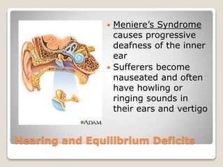 Hearing and Equilibrium Deficits
 Meniere’s Syndrome
causes progressive
deafness of the inner
ear
 Sufferers become
nauseated and often
have howling or
ringing sounds in
their ears and vertigo
 