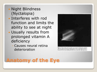 Anatomy of the Eye
 Night Blindness
(Nyctalopia)
 Interferes with rod
function and limits the
ability to see at night
 Usually results from
prolonged vitamin A
deficiency
◦ Causes neural retina
deterioration
 