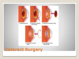 Cataract Surgery
 