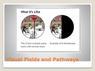 Visual Fields and Pathways
 