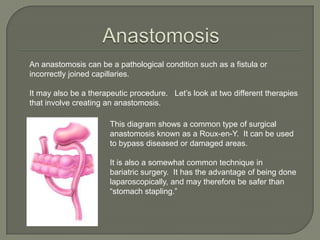 Anastomosis	An anastomosis can be a pathological condition such as a fistula or incorrectly joined capillaries.	It may also be a therapeutic procedure.   Let’s look at two different therapies that involve creating an anastomosis.This diagram shows a common type of surgical anastomosis known as a Roux-en-Y.  It can be usedto bypass diseased or damaged areas.It is also a somewhat common technique inbariatric surgery.  It has the advantage of being donelaparoscopically, and may therefore be safer than“stomach stapling.”