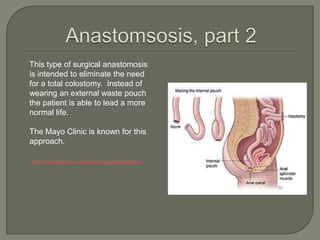 Anastomsosis, part 2	This type of surgical anastomosis is intended to eliminate the need for a total colostomy.  Instead of wearing an external waste pouch the patient is able to lead a more normal life.	The Mayo Clinic is known for this approach.http://www.mayoclinic.org/colostomy-sparing-surgery/