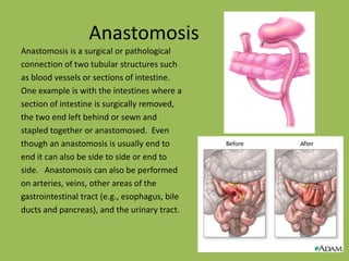 AnastomosisAnastomosis is a surgical or pathologicalconnection of two tubular structures suchas blood vessels or sections of intestine.One example is with the intestines where asection of intestine is surgically removed,the two end left behind or sewn andstapled together or anastomosed.  Eventhough an anastomosis is usually end toend it can also be side to side or end toside.   Anastomosis can also be performedon arteries, veins, other areas of thegastrointestinal tract (e.g., esophagus, bileducts and pancreas), and the urinary tract.  