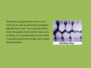 The crowns and part of the root of 2 or 3teeth can be seen as well as the immediateadjacent bone level.  The x-rays also detectcheck the quality of prior dental repair suchas fillings. It is recommended to have dentalx-rays done yearly even though your in gooddental condition.