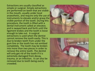 	Extractions are usually classified as simple or surgical. Simple extractions are performed on teeth that are visible in the mouth, usually under local anaesthetic, and require only the use of instruments to elevate and/or grasp the visible portion of the tooth. During this procedure, the tooth is lifted with a dental instrument called an elevator, and is swayed back and forth until the ligament brakes and the tooth is loose enough to take out.  A surgical extractions is used when the dentist cannot remove the tooth easily. This is due to broken teeth from under the gum line or the tooth has not emitted completely.  The tooth may be broken into more than two pieces in order to remove the entire tooth. The dentist will only get rid of the tooth if it is extremely damaged from decay, trauma, or an infection.  It can also be removed due to teeth being overly crowded.
