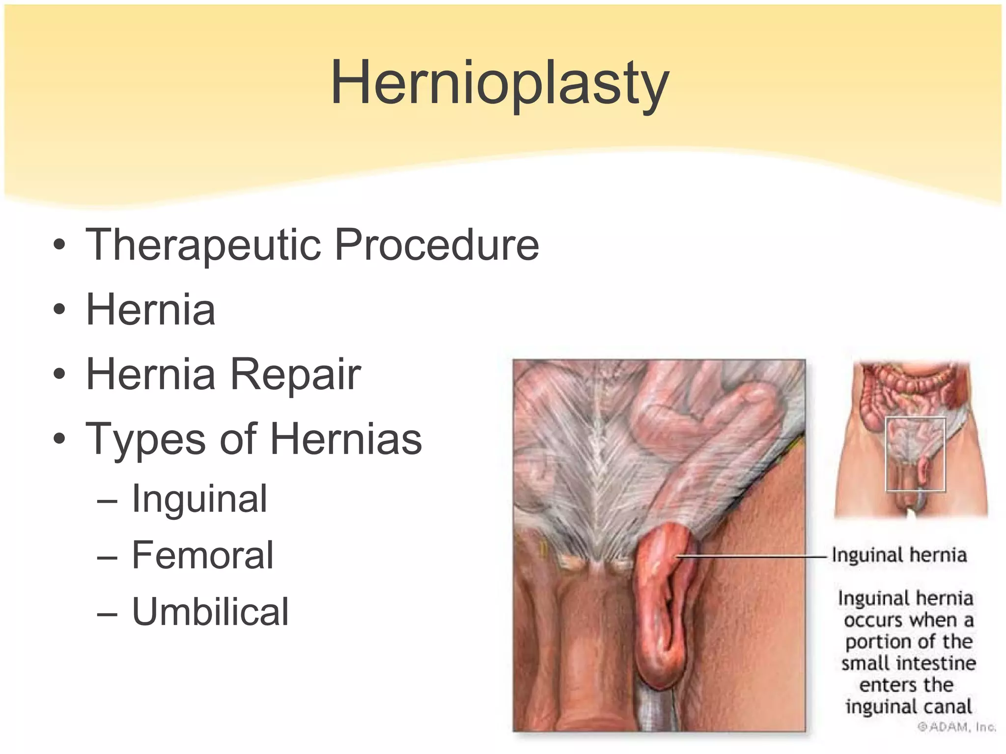 Hernioplasty

•   Therapeutic Procedure
•   Hernia
•   Hernia Repair
•   Types of Hernias
    – Inguinal
    – Femoral
    – Umbilical
 