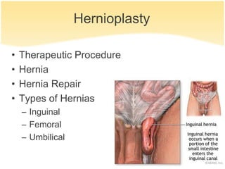 Hernioplasty

•   Therapeutic Procedure
•   Hernia
•   Hernia Repair
•   Types of Hernias
    – Inguinal
    – Femoral
    – Umbilical
 