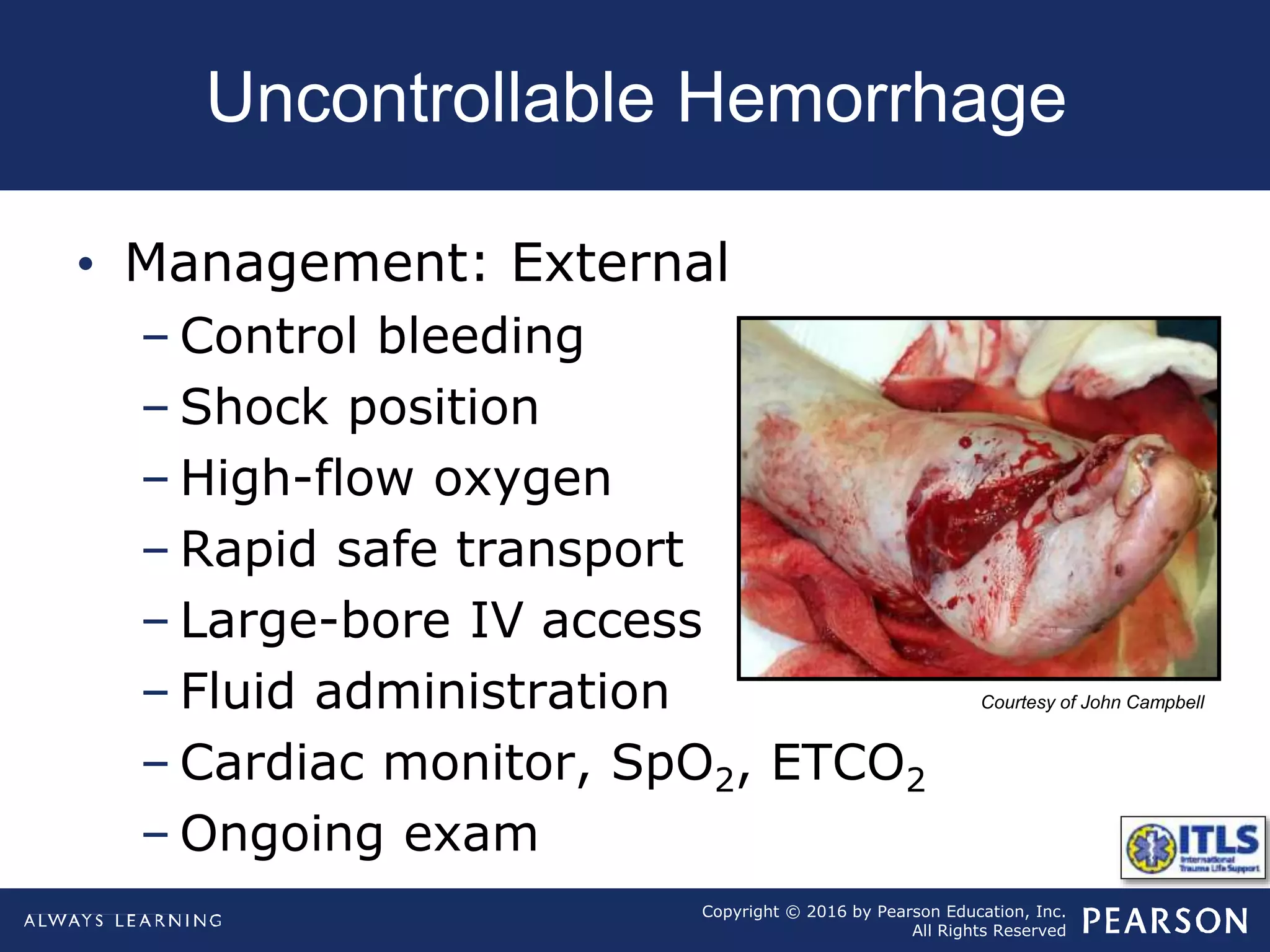 Copyright © 2016 by Pearson Education, Inc.
All Rights Reserved
Uncontrollable Hemorrhage
Courtesy of John Campbell
• Management: External
– Control bleeding
– Shock position
– High-flow oxygen
– Rapid safe transport
– Large-bore IV access
– Fluid administration
– Cardiac monitor, SpO2, ETCO2
– Ongoing exam
 