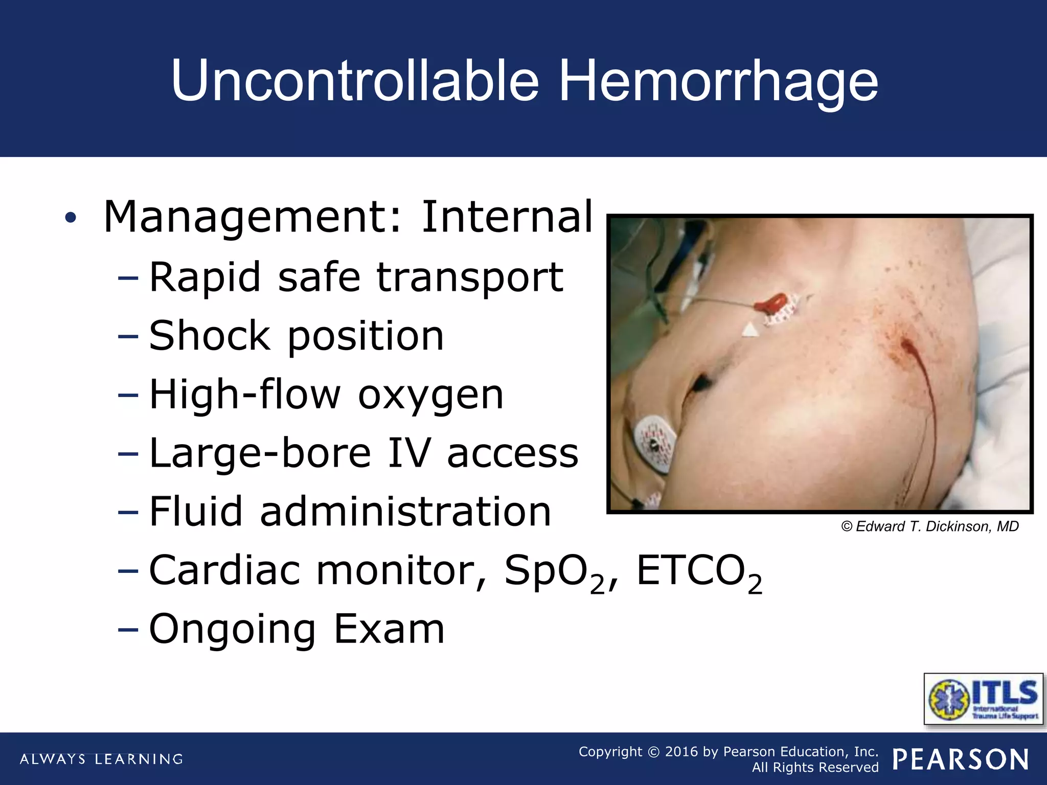 Copyright © 2016 by Pearson Education, Inc.
All Rights Reserved
Uncontrollable Hemorrhage
• Management: Internal
– Rapid safe transport
– Shock position
– High-flow oxygen
– Large-bore IV access
– Fluid administration
– Cardiac monitor, SpO2, ETCO2
– Ongoing Exam
© Edward T. Dickinson, MD
 