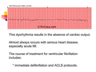 This dysrhythmia results in the absence of cardiac output. Almost always occurs with serious heart disease, especially acute MI. The course of treatment for ventricular fibrillation includes: * immediate defibrillation and ACLS protocols.  