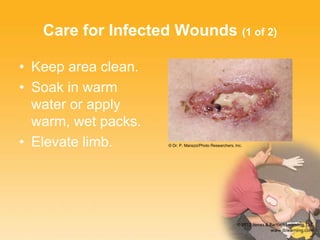 Care for Infected Wounds (1 of 2)
• Keep area clean.
• Soak in warm
water or apply
warm, wet packs.
• Elevate limb. © Dr. P. Marazzi/Photo Researchers, Inc.
 