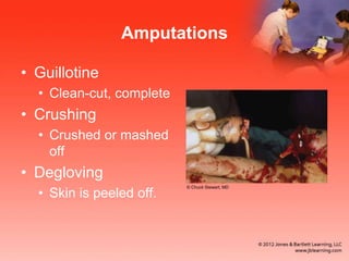 Amputations
• Guillotine
• Clean-cut, complete
• Crushing
• Crushed or mashed
off
• Degloving
• Skin is peeled off.
© Chuck Stewart, MD
 