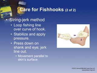 Care for Fishhooks (2 of 2)
• String-jerk method
• Loop fishing line
over curve of hook.
• Stabilize and apply
pressure.
• Press down on
shank and eye; jerk
line out.
• Movement parallel to
skin’s surface
 