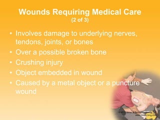 Wounds Requiring Medical Care
(2 of 3)
• Involves damage to underlying nerves,
tendons, joints, or bones
• Over a possible broken bone
• Crushing injury
• Object embedded in wound
• Caused by a metal object or a puncture
wound
 