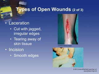 Chapter 9 Wounds | PPTX