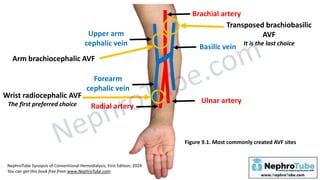 Hemodialysis: Chapter 9, Arteriovenous Fistula and Graft: Basics ...