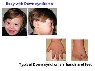 Baby with Down syndrome Typical Down syndrome’s hands and feet 
