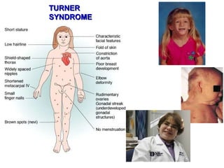 TURNER SYNDROME 