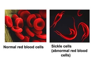 Normal red blood cells Sickle cells  (abnormal red blood  cells) 