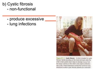 b) Cystic fibrosis - non-functional  _______________________ - produce excessive  _______________ - lung infections  