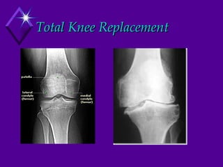 Total Knee Replacement 