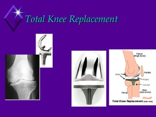 Total Knee Replacement 