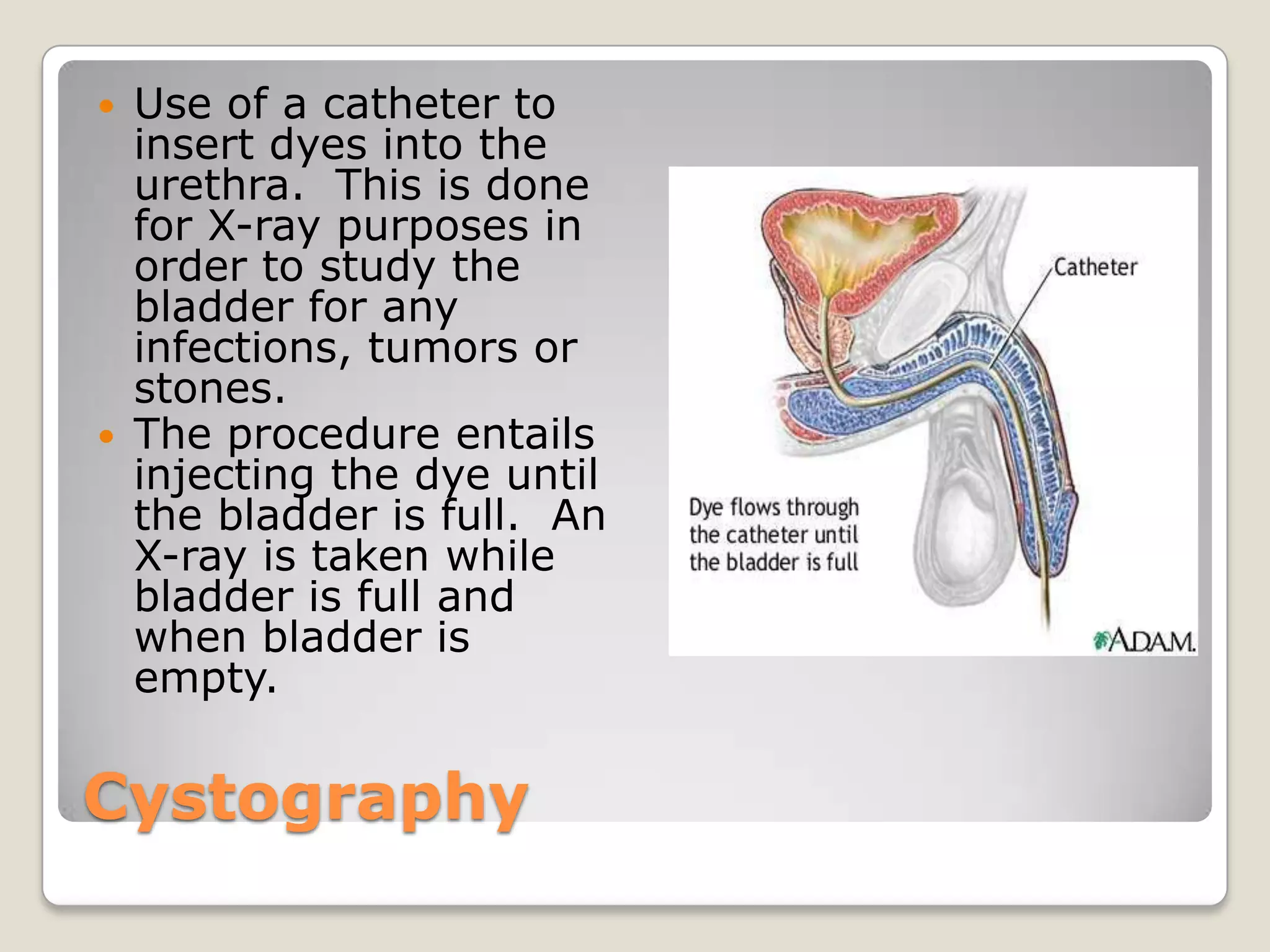 Characteristic of a balloon inflated at the end in order to stay in place of the urethra or bladder and the other end is attached to a drainage bag. The balloon is deflated when removal is needed.