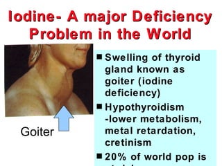 Iodine- A major Deficiency
   Problem in the World
           s Swelling of thyroid
             gland known as
             goiter (iodine
             deficiency)
           s Hypothyroidism
             -lower metabolism,
 Goiter      metal retardation,
             cretinism
           s 20% of world pop is
 