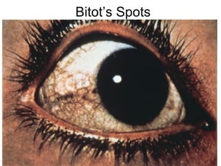 Bitot’s Spots
 
