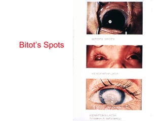 Bitot’s Spots
 