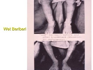 Wet Beriberi
 