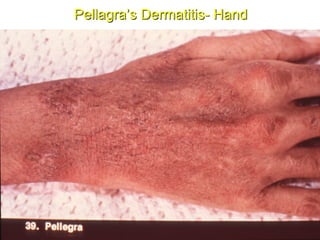 Pellagra’s Dermatitis- Hand
 