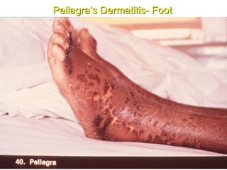 Pellagra’s Dermatitis- Foot
 