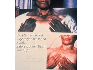 Casal’s Necklace &
Hyperpigmentation of
Hands:
Before & After Niacin
Therapy
 