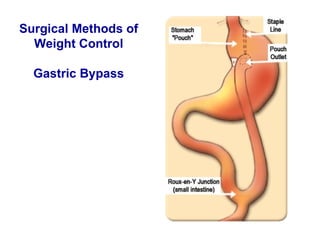 Surgical Methods of Weight Control Gastric Bypass 