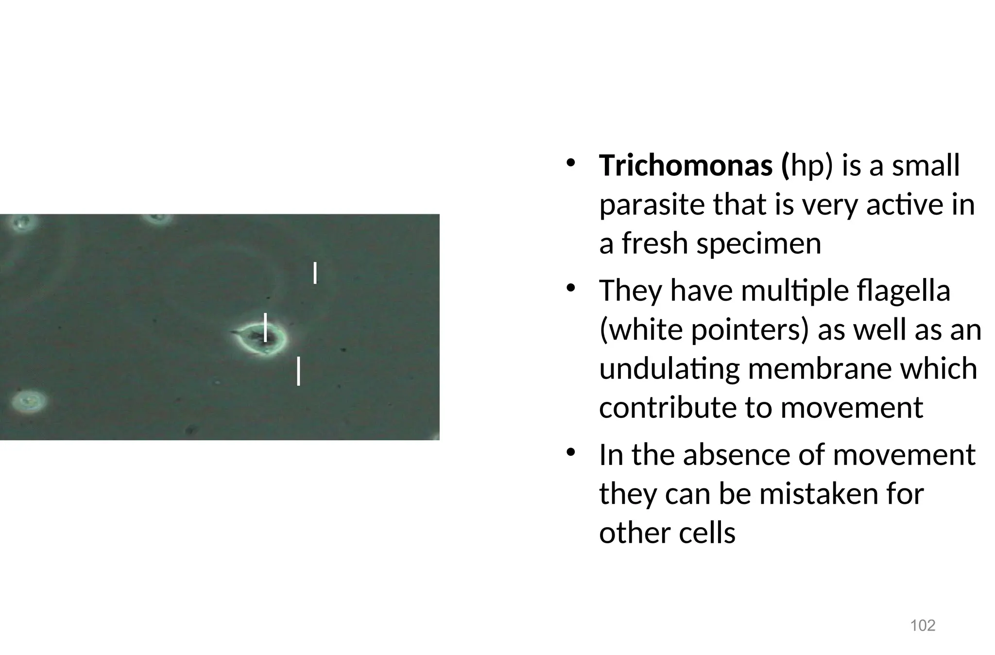 102
• Trichomonas (hp) is a small
parasite that is very active in
a fresh specimen
• They have multiple flagella
(white pointers) as well as an
undulating membrane which
contribute to movement
• In the absence of movement
they can be mistaken for
other cells
 